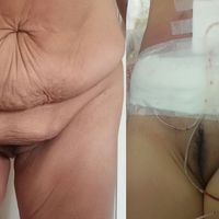 Dermolipectomía en Abdómenes Péndulos