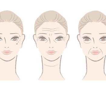Novedad en Medicina Estética: la bioestimulación mecánica con hilos intradérmicos