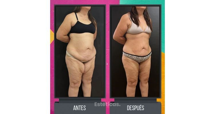 Lipedema: Una condición subdiagnosticada y su tratamiento quirúrgico.