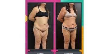 Lipedema: Una condición subdiagnosticada y su tratamiento quirúrgico.