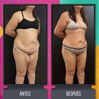 Lipedema: Una condición subdiagnosticada y su tratamiento quirúrgico.