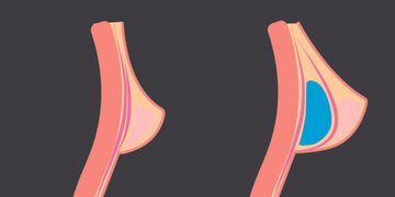 Implantes Mamarios: Detrás del Músculo Pectoral