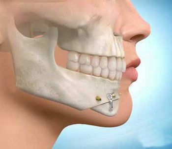 cirugia buco maxilo facial Cirugia buco maxilo facial