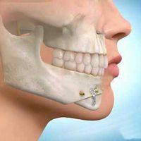 Todo lo que necesitás saber sobre la cirugía maxilofacial