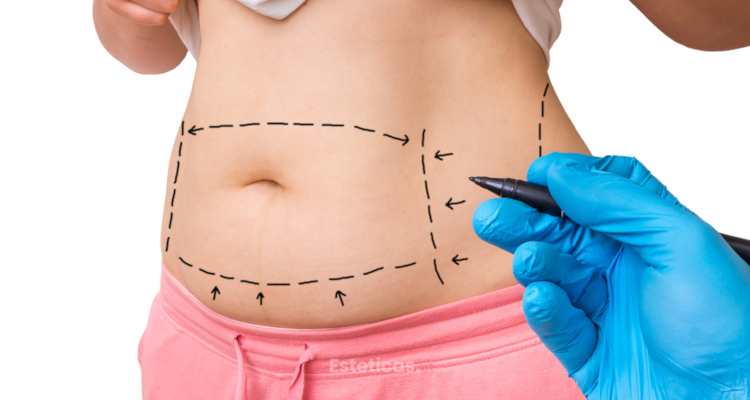 ¿Abdominoplastía o dermopilectomía? ¿Cúal me conviene?