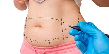 ¿Abdominoplastía o dermopilectomía? ¿Cúal me conviene?