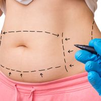 ¿Abdominoplastía o dermopilectomía? ¿Cúal me conviene?