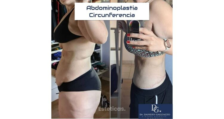 ¿Por qué queda ese abdomen prominente o "tripa" después de los embarazos?