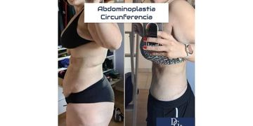 ¿Por qué queda ese abdomen prominente o "tripa" después de los embarazos?