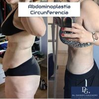 ¿Por qué queda ese abdomen prominente o "tripa" después de los embarazos?