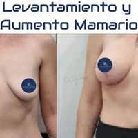 ¿Estás pensando en un levantamiento mamario?