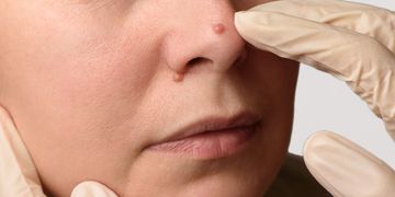 ¿Qué tratamientos existen para eliminar las verrugas?
