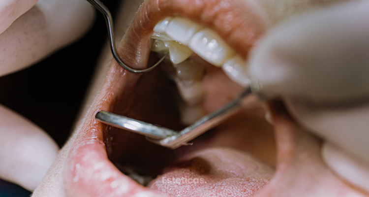 ¿Cuándo se necesita hacer una endodoncia?