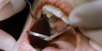 ¿Cuándo se necesita hacer una endodoncia? ¿Cuándo se necesita hacer una endodoncia?