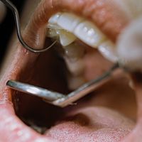 ¿Cuándo se necesita hacer una endodoncia?