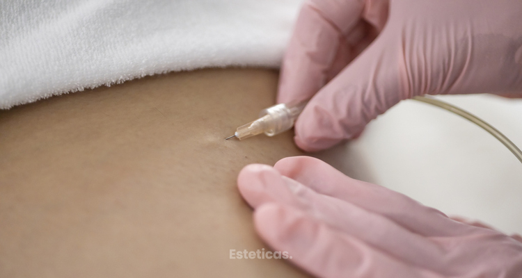 La carboxiterapia y la diferencia con la mesoterapia