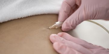 La carboxiterapia y la diferencia con la mesoterapia