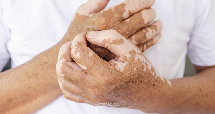 Vitiligo: ¿Existe una cura milagrosa?