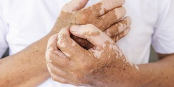 Vitiligo: ¿Existe una cura milagrosa?