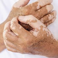 Vitiligo: ¿Existe una cura milagrosa?