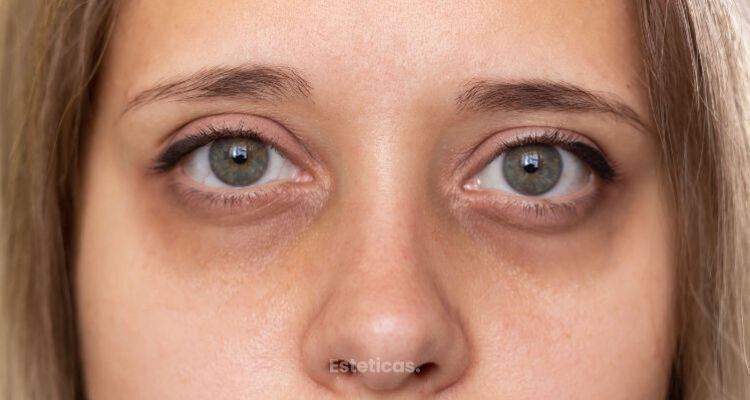 ¿Por qué se te marcan las ojeras y cómo debes tratarlas?