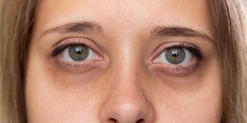 ¿Por qué se  te marcan las ojeras y cómo debes tratarlas?