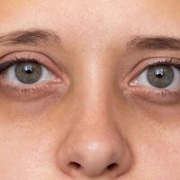 ¿Por qué se  te marcan las ojeras y cómo debes tratarlas?