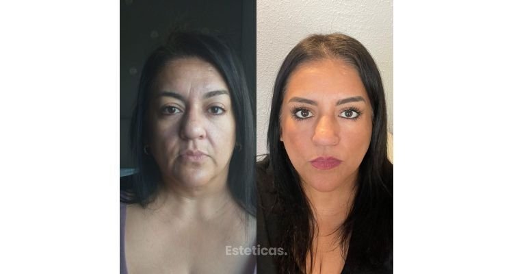 Endolift facial.