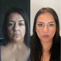 Endolift facial.