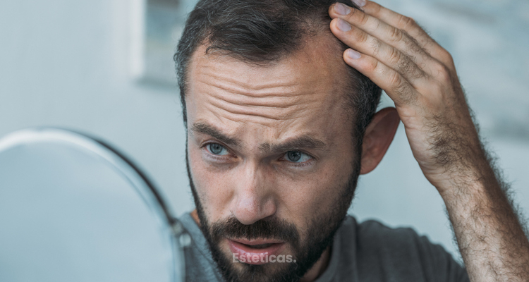 Alopecia vs caída del cabello