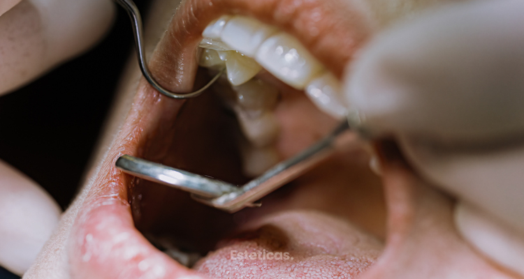 Endodoncia y Extracción: ¿qué es mejor para salvar tu diente?