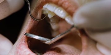 Endodoncia y Extracción: ¿qué es mejor para salvar tu diente? Endodoncia y Extracción: ¿qué es mejor para salvar tu diente?