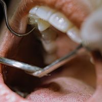 Endodoncia y Extracción: ¿qué es mejor para salvar tu diente?