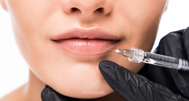Hialuronidasa en los labios: Una solución para corregir y revertir