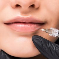 Hialuronidasa en los labios: Una solución para corregir y revertir