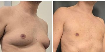 Ginecomastia sin cortes