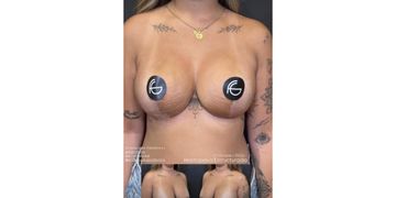 Mastopexia Estructurada: Técnica moderna que permite remodelar la mama completamente y tener resultados duraderos Mastopexia Estructurada: Técnica moderna que permite remodelar la mama completamente y tener resultados duraderos
