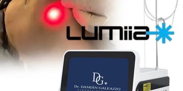 El lifting sin cirugía que está revolucionando la estética Endoláser con Lumiia El lifting sin cirugía que está revolucionando la estética Endoláser con Lumiia