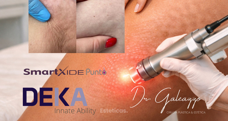 La revolución anti-celulitis llegó con el láser CO2 fraccionado DEKA