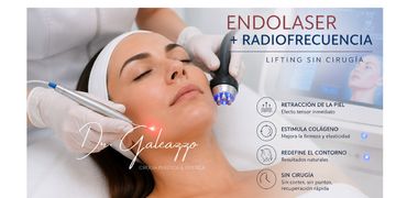 Endolaser + radiofrecuencia: el “lifting sin cirugía” que está cambiando la forma de tratar la flacidez