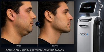 Endoláser para definir mandíbula y tratar la papada: el procedimiento que cada vez más pacientes eligen para el rostro sin cirugía tradicional Endoláser para definir mandíbula y tratar la papada: el procedimiento que cada vez más pacientes eligen para el rostro sin cirugía tradicional