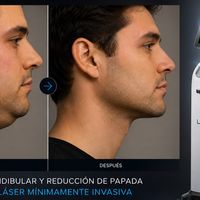 Endoláser para definir mandíbula y tratar la papada: el procedimiento que cada vez más pacientes eligen para  el rostro sin  cirugía tradicional