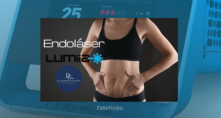 Endoláser Lumiia después de la maternidad: el tratamiento que muchas mujeres eligen para mejorar la “tripita” del bajo vientre sin una cirugía tipica