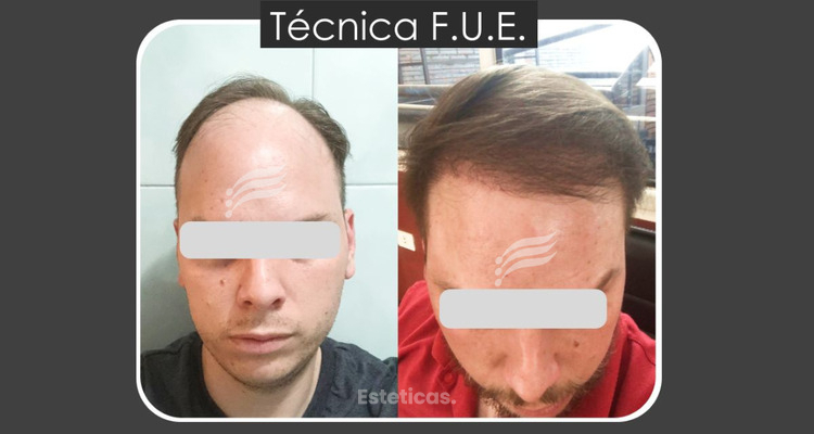 Implante capilar: cómo saber si realmente sos candidato y por qué la técnica Zafiro está cambiando los resultados