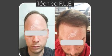 Implante capilar: cómo saber si realmente sos candidato y por qué la técnica Zafiro está cambiando los resultados