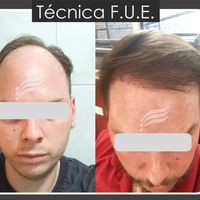 Implante capilar: cómo saber si realmente sos candidato y por qué la técnica Zafiro está cambiando los resultados