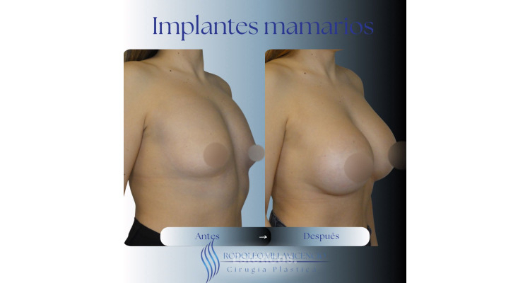 Implantes Mamarios, cuidados, ventajas y expectativas