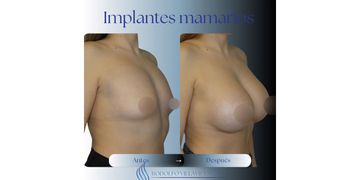 Implantes Mamarios, cuidados, ventajas y expectativas Implantes Mamarios, cuidados, ventajas y expectativas