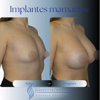 Implantes Mamarios, cuidados, ventajas y expectativas Implantes Mamarios, cuidados, ventajas y expectativas
