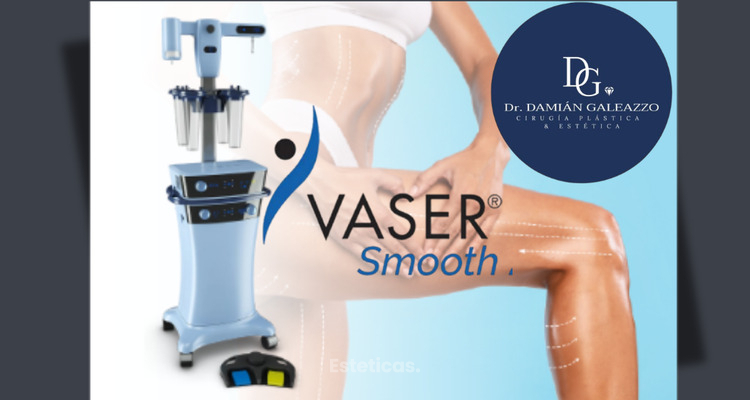 VASER Smooth: la tecnología que redefine el tratamiento de la celulitis y la calidad de la piel
